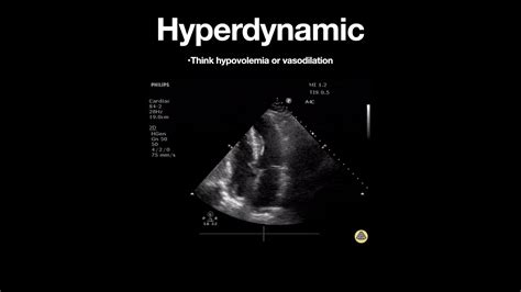 hyperdynamic left ventricular function meaning.